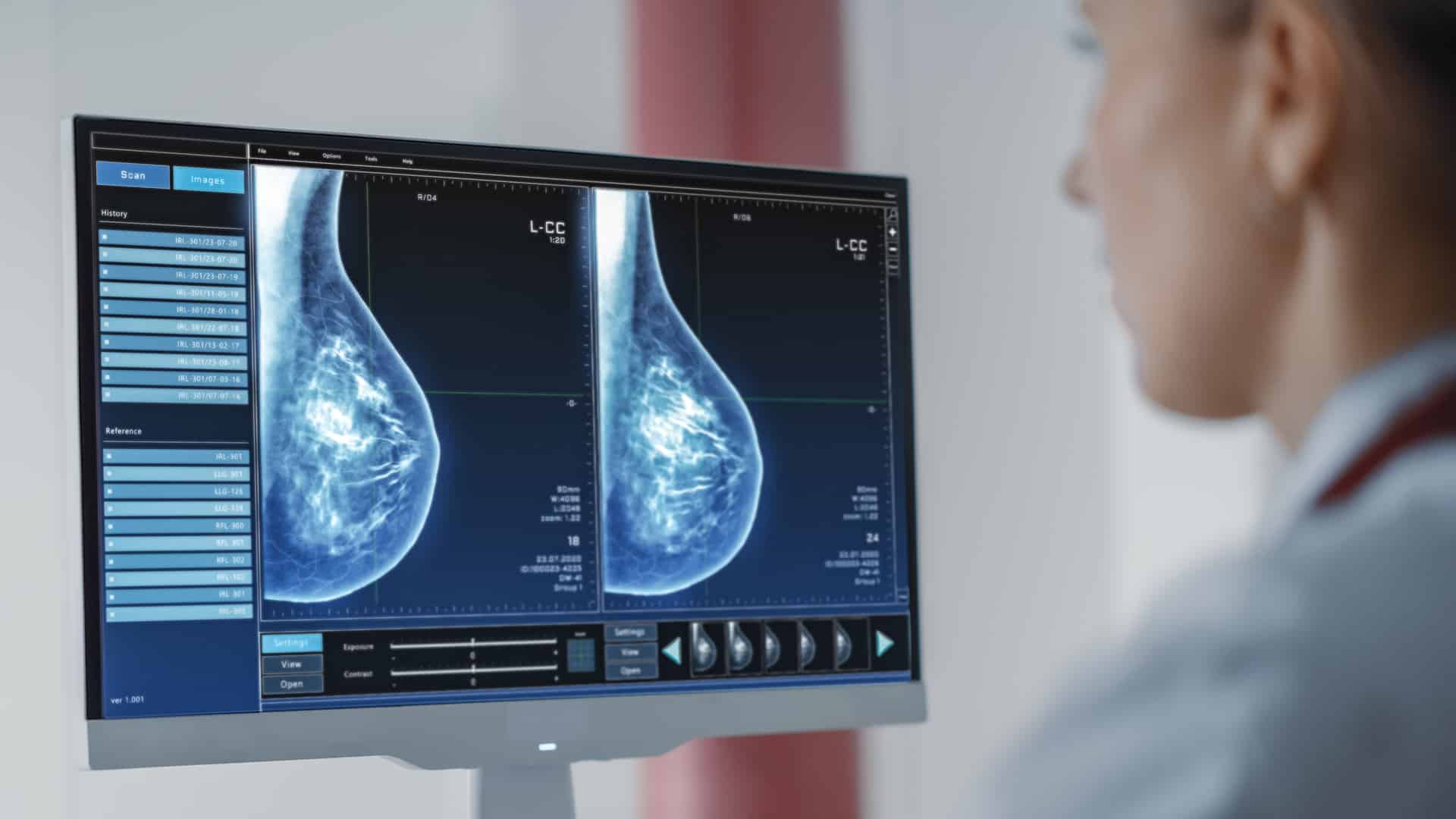AI a mellrák ellen: négy startup, amely életeket menthet